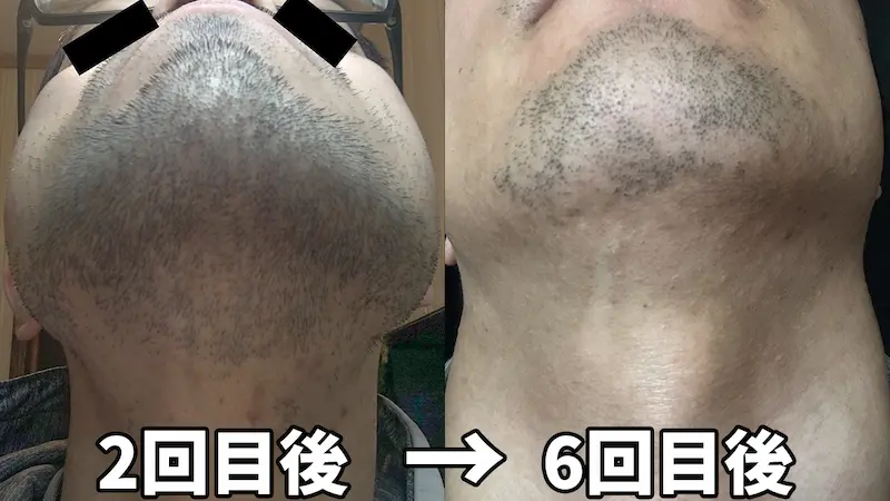 湘南美容クリニックのヒゲ脱毛（あご下）の2回目後と6回目後の比較写真