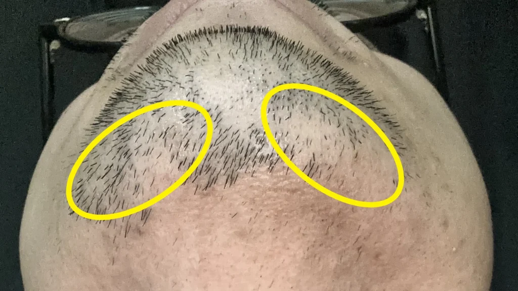 湘南美容クリニックのジェントルレイズのヒゲ脱毛で一番痛かった部位はあごのフェイスライン