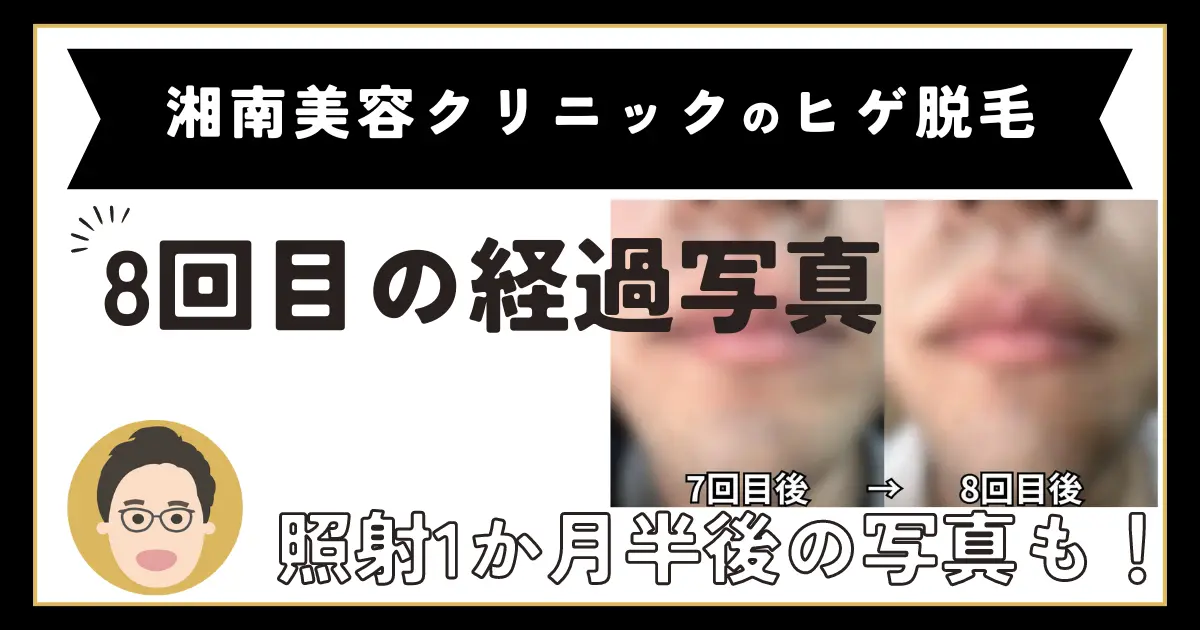 湘南美容クリニックのヒゲ脱毛8回目の体験記事のアイキャッチ